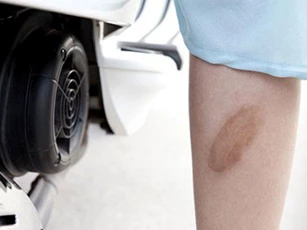 Mẹo chữa bỏng bô cực nhanh không để lại sẹo