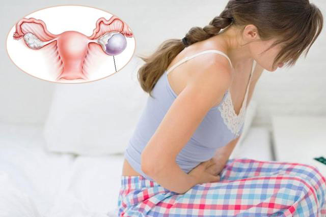 Dấu hiệu cảnh báo buồng trứng đa nang