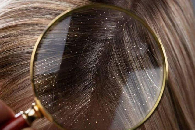 Cách giúp bạn trị gàu ống hiệu quả