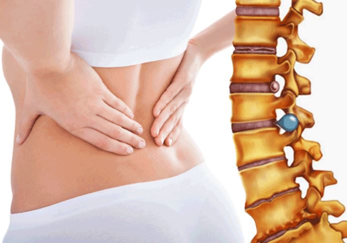7 nguyên nhân dẫn đến thoát vị đĩa đệm tuyệt đối không nên chủ quan