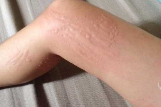 6 dấu hiệu cảnh báo gan đầy độc tố, chức năng ngày càng suy yếu, chẳng mấy chốc mà nát bấy