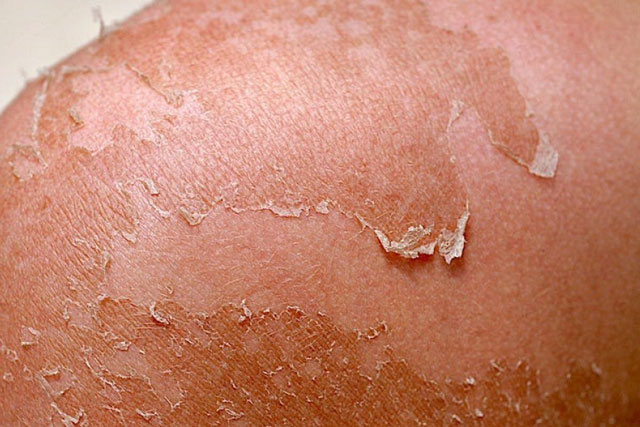 Mách bạn cách điều trị bong tróc da do cháy nắng