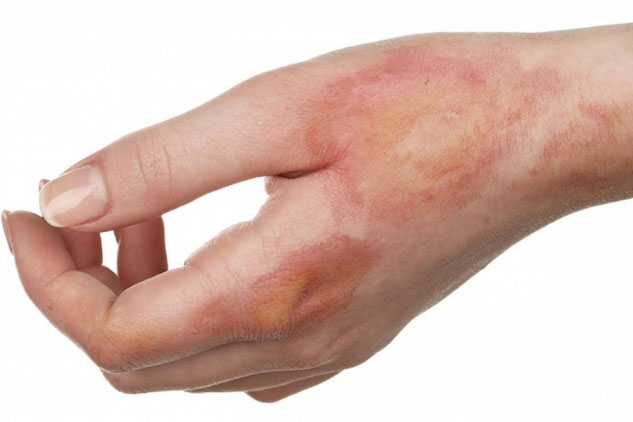 5 biện pháp làm dịu vết bỏng tại nhà