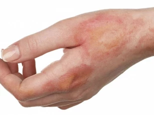 5 biện pháp làm dịu vết bỏng tại nhà