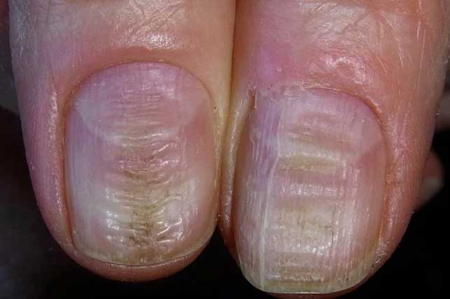 Nhiều người bị tiểu đường mà không biết: Bác sĩ mách cách nhìn vào móng tay để tự phát hiện