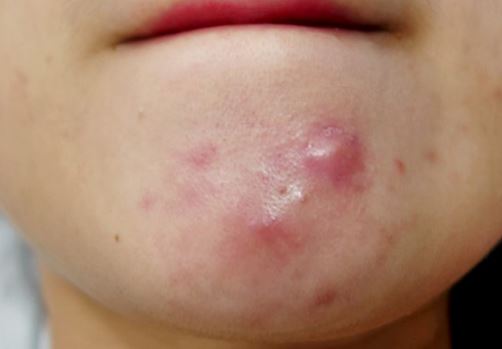 Chị em đua nhau trị mụn bọc tại nhà