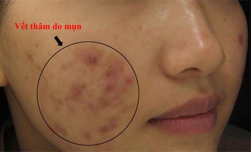 Công thức dễ nhất giúp bạn điều trị mụn và vết thâm