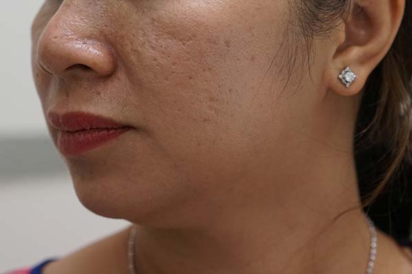 Hết sẹo rỗ chỉ bằng 1 quả trứng gà