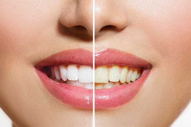 10 thói quen khiến hàm răng hư hỏng nhưng 90% người Việt mắc phải