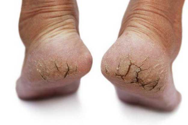 6 dấu hiệu trên bàn chân cảnh báo nguy cơ mắc tiểu đường hoặc bệnh tim, số 4 thấy là phải đi viện gấp