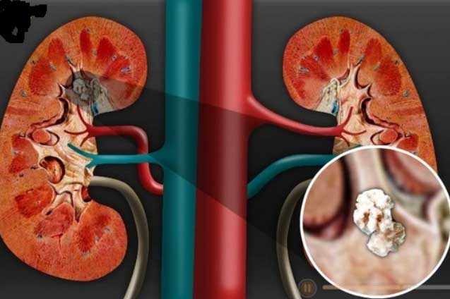 Nếu thấy dấu hiệu này, hãy cảnh giác với căn bệnh sỏi thận đang tấn công cơ thể