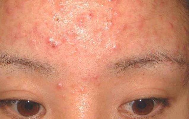 6 dấu hiệu cho thấy trong cơ thể bạn đang chứa quá nhiều độc tố, chỉ có một trong số đó cũng cần chú ý