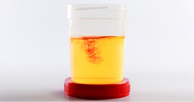 Dù nam hay nữ, nếu thấy 3 dấu hiệu này khi đi tiểu thì nên đi khám ngay