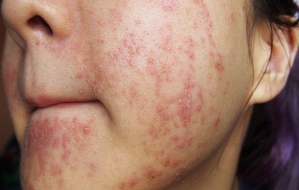 Mụn chi chít vì thói quen tưởng chừng như vô hại