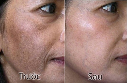 Dùng đá lạnh khoai tây nám da bao nhiêu cũng được lột sạch