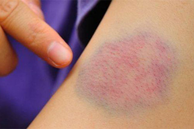 Bật mí 5 cách đánh tan máu bầm bằng những nguyên liệu đơn giản, nhà ai cũng có