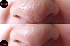 Dùng dưa chuột chấm đường chà vào mặt mụn đầu đen tự bong hết