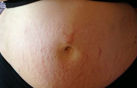 Mẹo chữa rạn da trong "nháy mắt" mà không cần dùng mỹ phẩm