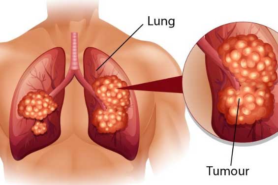 5 loại ung thư nguy hiểm có tính di truyền, nhà có người mắc thì con cái cần đi khám sàng lọc sớm