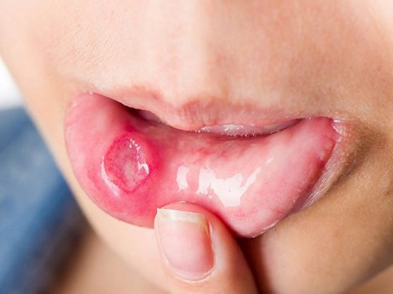 Đảm bảo hết nhiệt miệng sau 1 đêm mà không phải uống thuốc tây