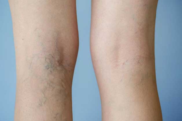 4 thói quen khiến cho bạn bị giãn tĩnh mạch, nhất là điều thứ 4