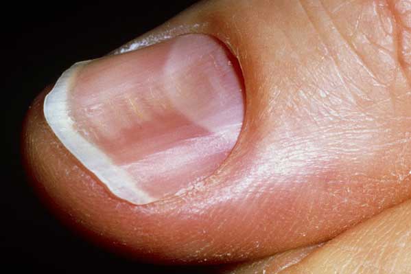 4 dấu hiệu lạ ở móng tay báo động bạn bị bệnh tiểu đường, nguy hiểm nhất là số 1