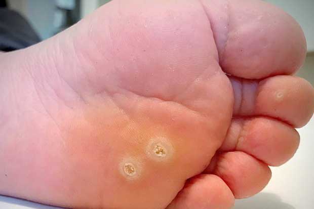 Nếu thấy chân có 3 biểu hiện bất thường này thì đi khám ngay kẻo mắc bệnh ung thư cổ tử cung