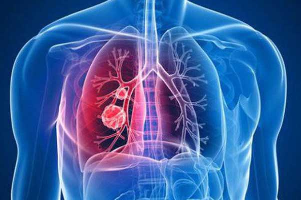 Thấy dấu hiệu này: Hãy nghĩ ngay đến lời cảnh báo của phổi, cẩn thận cơ thể đang nhiễm độc trầm trọng