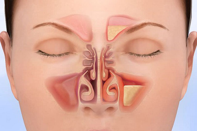Cách cải thiện tình trạng viêm xoang tại nhà