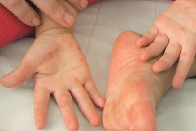 Những lưu ý khi phòng bệnh cho trẻ lúc giao mùa thu đông