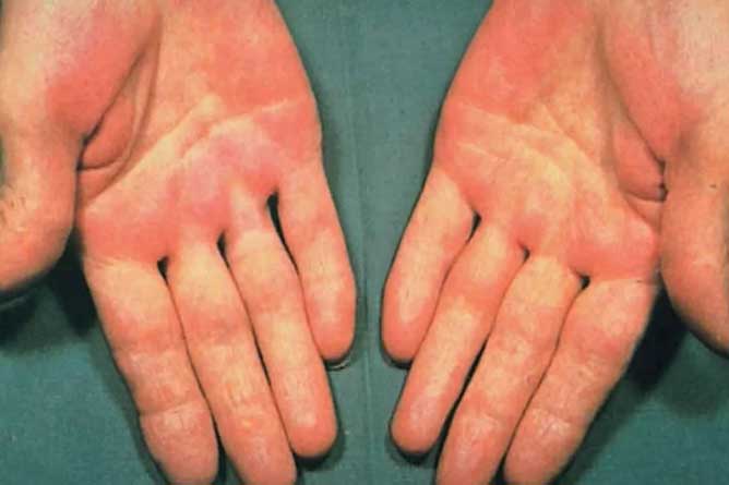 7 dấu hiệu ở tay cảnh báo vấn đề sức khỏe không nên chủ quan