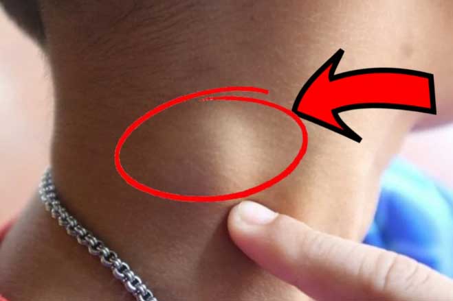 Người sắp bị K tấn công thường có 3 dấu hiệu lạ ở cổ, có dù chỉ 1 cũng báo động sức khoẻ