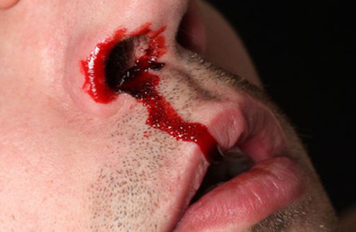 Chết lúc nào không hay vì chủ quan khi bị chảy máu cam