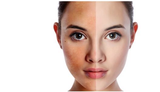 Bị nám da lâu năm 'buộc' phải dùng công thức này