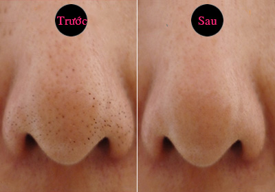 5 công thức trị sạch mụn đầu đen bằng trứng gà ai cũng làm được