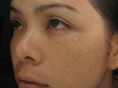 Lý do đốm nâu xuất hiện trên da