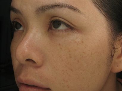 Lý do đốm nâu xuất hiện trên da
