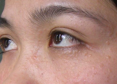 Hết ngay mụn thịt chỉ với 1 củ tỏi