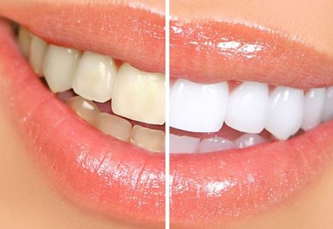 Răng bạn có vàng ố tới mấy cũng trắng ngay lập tức khi dùng chanh cách này