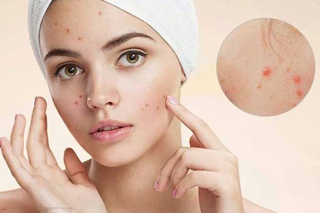 Chỉ trong 1 đêm bạn có thể làm sạch mụn trứng cá mà không mất tiền bằng 4 mẹo đơn giản sau