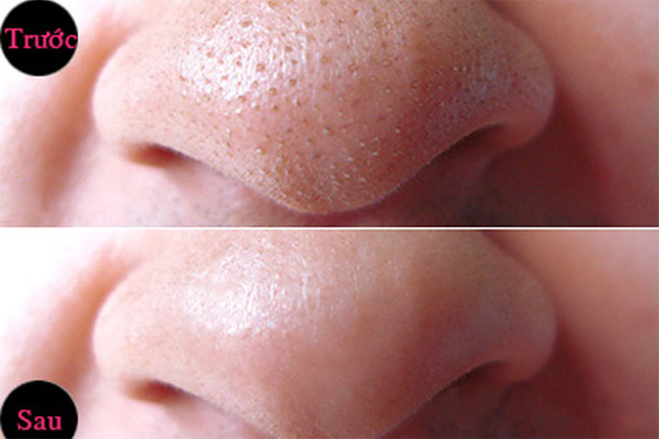 Mụn đầu đen tự chui ra chỉ với 1 quả chanh tươi