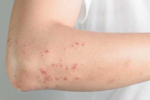 2 chỗ bị ngứa là dấu hiệu gan bị tổn thương nghiêm trọng, đừng chủ quan