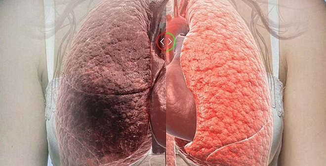 Thực phẩm thanh lọc phổi đặc biệt hiệu quả, dù với người hút thuốc lá nhiều năm