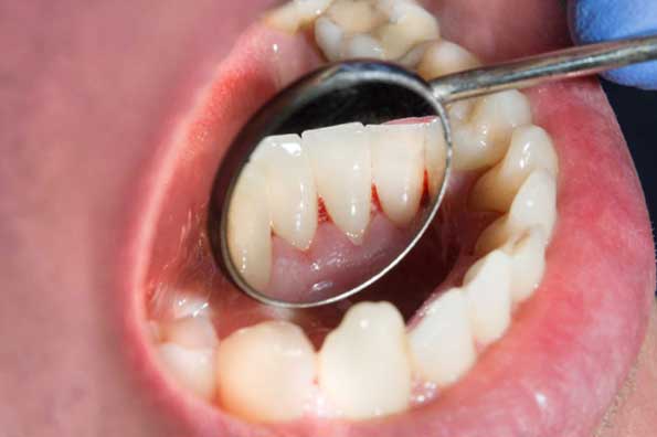 Chảy máu chân răng là dấu hiệu của 5 bệnh nguy hiểm, chớ nên xem thường