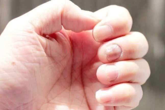 5 triệu chứng lặp đi lặp lại cảnh báo gan đang bị nhiễm độc, hãy tới gặp bác sĩ ngay còn kịp