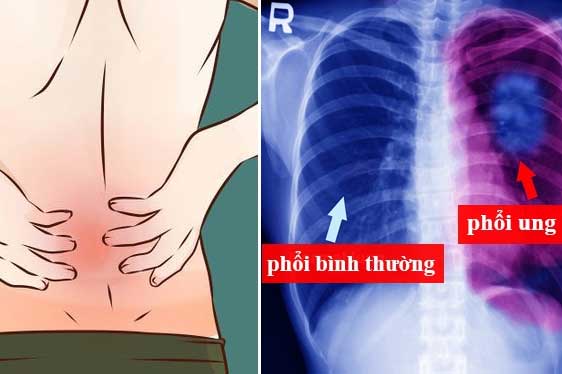 7 dấu hiệu sớm của ung thư phổi rất nhiều người bỏ qua, nguy hiểm nhất là số 5