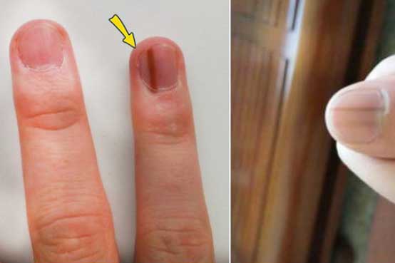 Thấy bàn tay có 1 trong 4 dấu hiệu này: Đi khám ngay vì cơ thể đang cảnh báo bệnh nguy hiểm