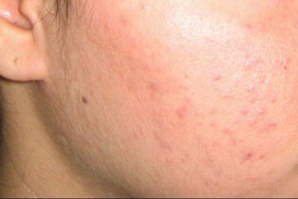 Bí quyết để cả ngày Tết da không hề nổi mụn