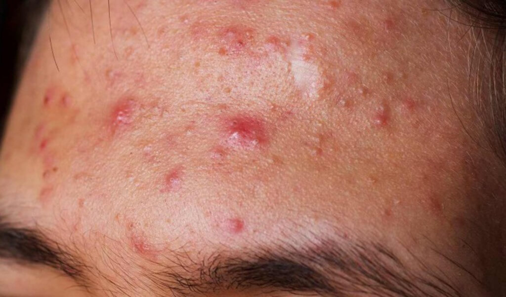Cách giúp bạn phòng ngừa mụn trên trán