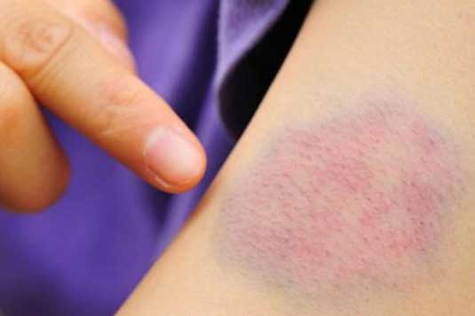 Bầm tím bất thường trên da: 7 vấn đề sức khỏe bạn có thể gặp phải, đừng chủ quan